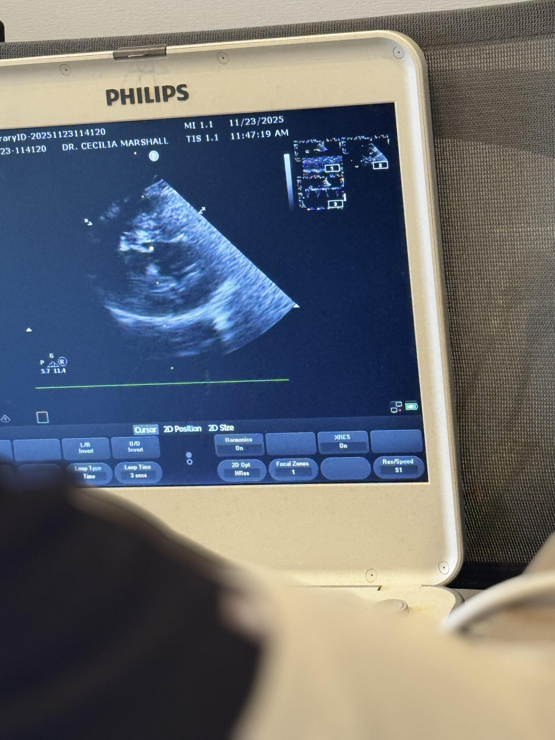 Philips ultrasound monitor displaying sonogram image